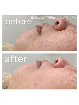 ラクシー 北千住(luxssy)/口周りシェービング