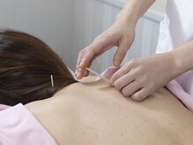 ブレア 銀座/施術写真【自律神経/虎ノ門/鍼】