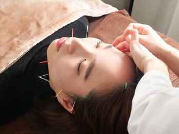 ベルルーナ(Belle-Lune)/美容鍼