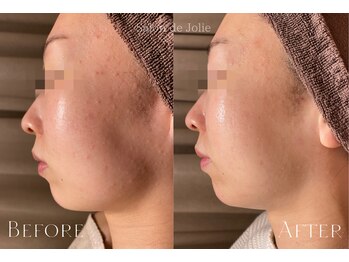 サロンドジョリー(Salon de Jolie)/【ハーブピーリング3回】