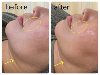 ほねつぎ一休さん 宇品店/小顔フェイシャル