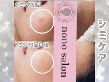 ノノサロン(nono salon)/シミケアbefore after