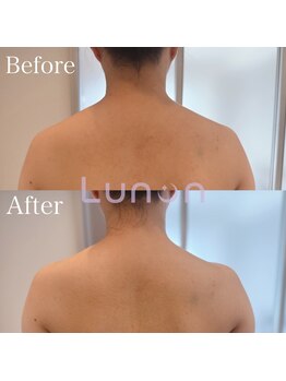 ルノン(Lunon)/肩甲骨はがし