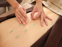 【鍼灸・美容鍼・オイルマッサージ】鍼灸で自己治癒力を高める。