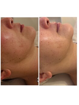 ランティル(l’until)の写真/ダイエットでも落ちない顔の脂肪。輪郭からはみ出る脂肪。二重アゴの脂肪を分解。すっきり小顔になります。