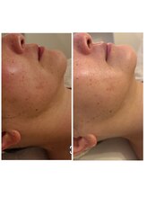 ランティル(l’until)