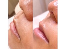 エミレ(emire)の雰囲気(気になる頑固な毛や角質もオフ!ワントーン明るい素肌へ☆)