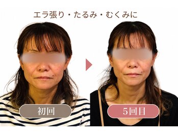 オルグル(OLGUL)の写真/アラフォーからの小顔矯正 エラ張り・たるみ・むくみを改善!ほうれい線にも◎
前橋小顔矯正 前橋コルギ