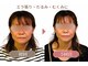 オルグル(OLGUL)の写真/アラフォーからの小顔矯正 エラ張り・たるみ・むくみを改善!ほうれい線にも◎
前橋小顔矯正 前橋コルギ