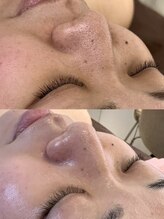 サロンメロウ 大牟田店(salon mellow)/毛穴洗浄で毛穴悩み、丸ごと改善