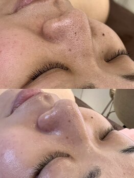 サロンメロウ 大牟田店(salon mellow)/毛穴洗浄で毛穴悩み、丸ごと改善
