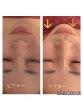 アンリール 旭川店(Anrire)/フェイシャル施術のお客様です！