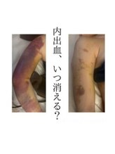 インディバケアプラチナム 横浜店/インディバ施術