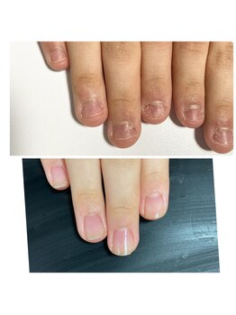 ウェルズユキ(well's yuki)/自爪育成/深爪/噛み爪/ちび爪