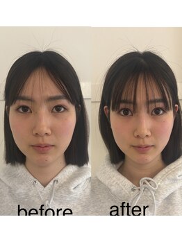 マホロバ(mahoroba)/美容鍼+頭皮鍼