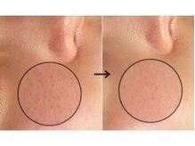 ラエッセ 目黒 白金台店(LAESSE)/毛穴・美白専門店 LAESSE 白金台