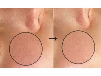 ラエッセ 目黒 白金台店(LAESSE)/毛穴・美白専門店 LAESSE 白金台