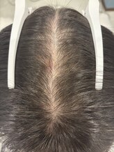 フォーケア(4Care)/プロセル頭皮改善トリートメント