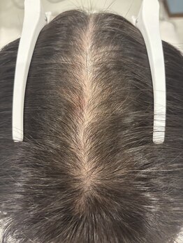 フォーケア(4Care)/プロセル頭皮改善トリートメント