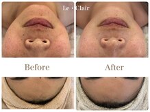 スキンセラピーサロン ル クレール(Le Clair)/Before→After