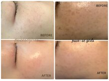 パーチェスガールズ 姪浜店(Pace-se Girls)の雰囲気(ダウンタイムなしの美肌シミケアで透明感のあるお肌に変身!)