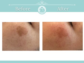 シミケアゼロ美人 表参道店(シミケアZERO美人)/【シミケア★シミゼロ症例】