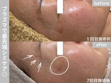 サロン ビュー(salon view)/40代女性〈シミ悩み〉　