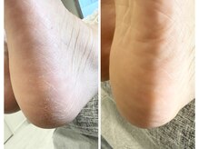 シュガーズネイル(sugar's nail)/角質ケア