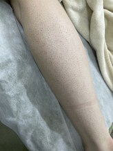 ナノハナ/鹿沼市の全身脱毛のナノハナ