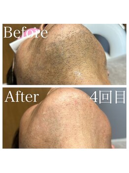 エピノン 山口岩国店(Epinon)/顔脱毛4回ビフォーアフター