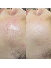 アロー(Allo!)/ハーブピーリング5回お肌変化