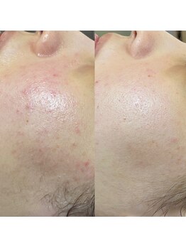 アロー(Allo!)/ハーブピーリング5回お肌変化