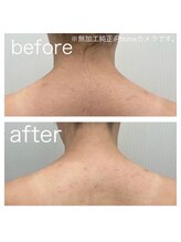 ラクシー 北千住(luxssy)/お背中シェービング