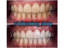 ホワイトニングショップ 鳥取店/ホワイトニングビフォーアフター