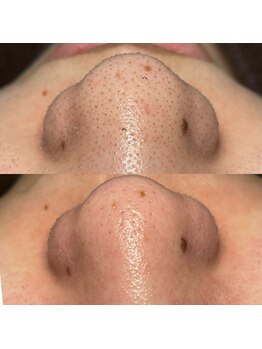 ビエン(bien)/韓国式3D毛穴洗浄