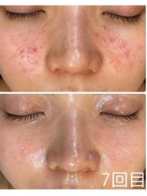 アレーズファイブフォー(A’LAISE54)/ニキビケア