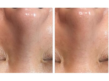 ラヴィエール(Laviere)/ハイドロピーリング