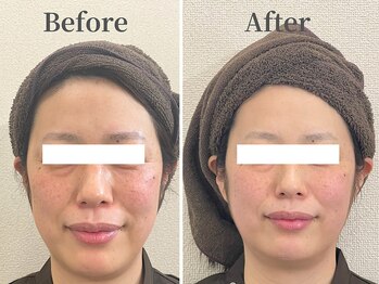 ハリニーク 銀座店(HARINIQ)/美容鍼before→after