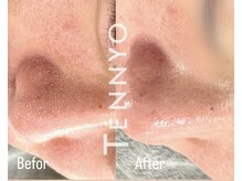 アヌヘア(Anuhea)/肌質毛穴洗浄で毛穴レス水光肌