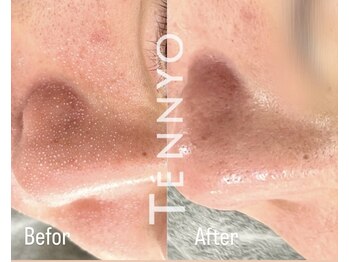 アヌヘア(Anuhea)/肌質毛穴洗浄で毛穴レス水光肌