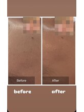 アンジュ(ANGE)/ガリレオピーリング症例毛穴