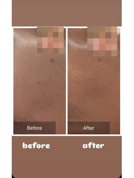 アンジュ(ANGE)/ガリレオピーリング症例毛穴