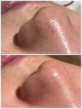 フォルチェ はません店(Folche)/毛穴/黒ずみ/ハイドロ