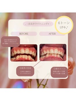 プラスビーセルフ(+b self)/ホワイトニングビフォーアフター