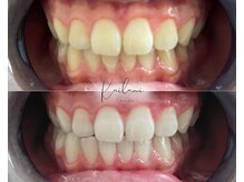 カイラニ サロン(Kai lanl salon)/ホワイトニング