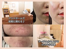 フェリス(feliz)の雰囲気（癒されながら素肌美人に♪ララピール/ハーブピーリング/プラズマ）