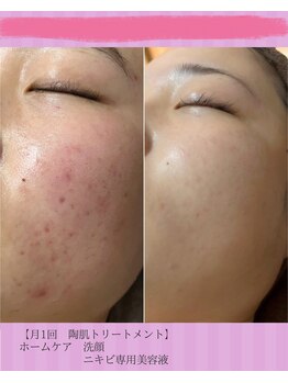 ホリホック/ニキビケア症例