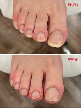 レフス 北参道店(REFUSS)/爪カッティング