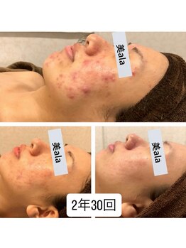 ビアラ(美ala)/ニキビケア/2年30回