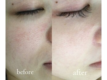 トリートメントルーム フェリーチェ(Felice)/めざせ!毛穴レス